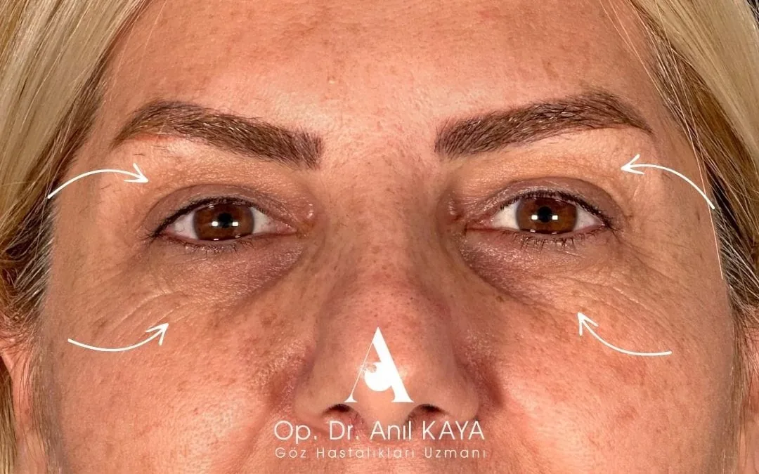 Göz kapağı estetiği öncesi sonrası — 11. vaka, sonrası
