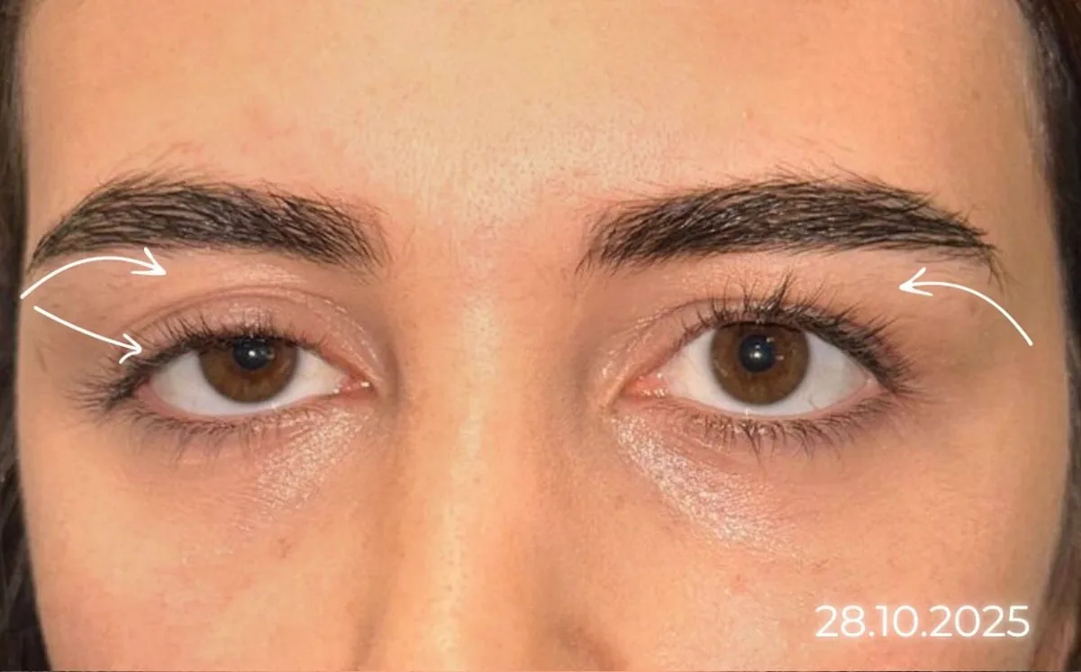 Göz kapağı estetiği öncesi sonrası — 18. vaka, öncesi