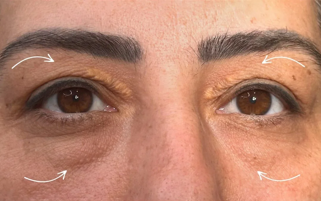 Göz kapağı estetiği öncesi sonrası — 5. vaka, öncesi