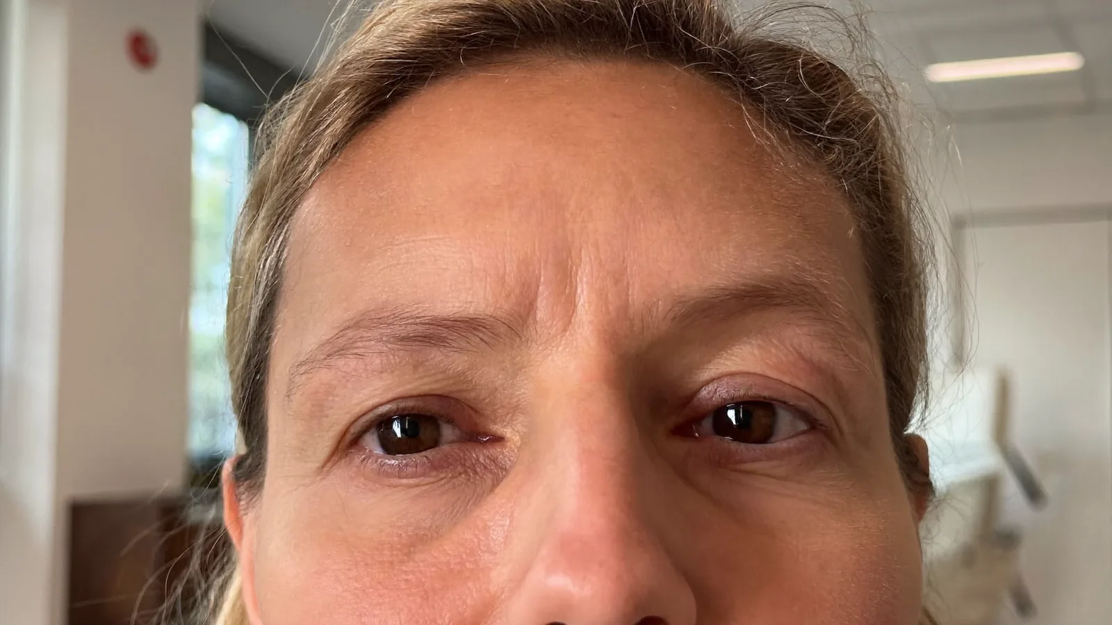Blepharoplasty in Turkey