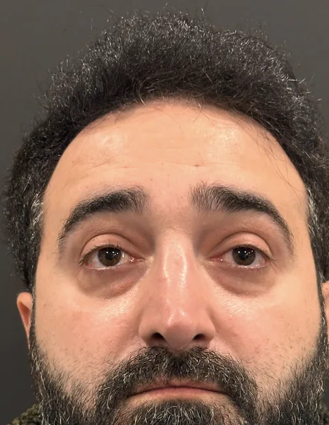 Lower blepharoplasty before and after in Istanbul — case 1, photo 1