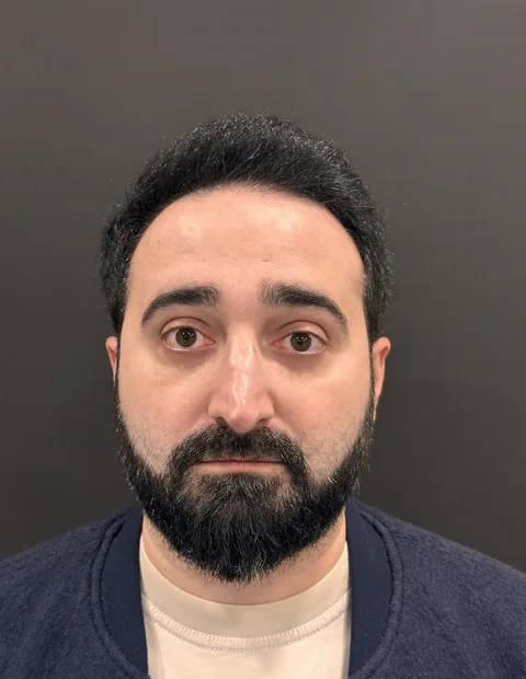 Lower blepharoplasty before and after — case 1, photo 2