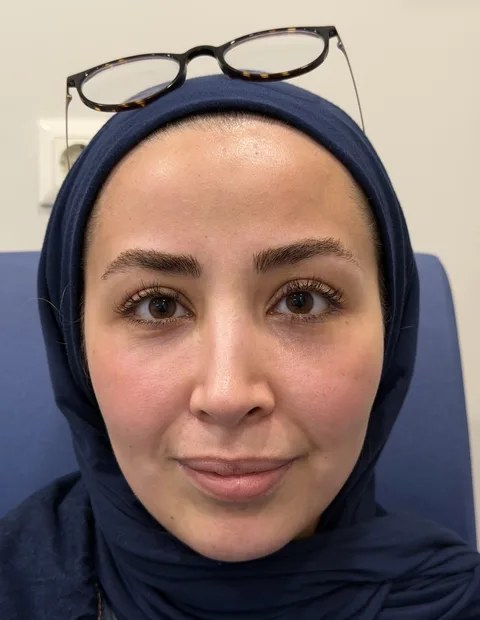 Lower blepharoplasty before and after — case 2, photo 1
