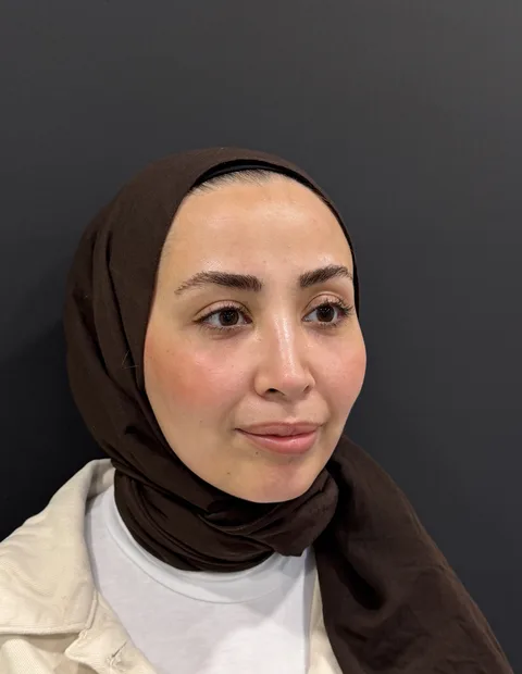 Lower blepharoplasty before and after — case 2, photo 2