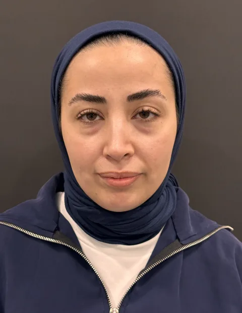 Lower blepharoplasty before and after — case 2, photo 3