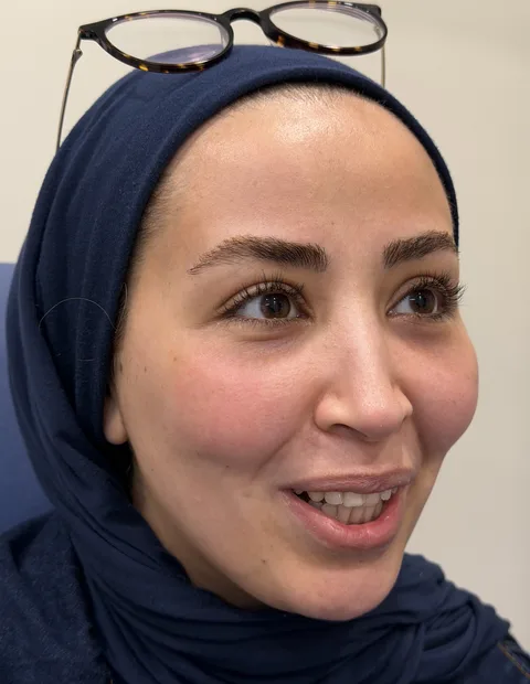 Lower blepharoplasty before and after — case 2, photo 4