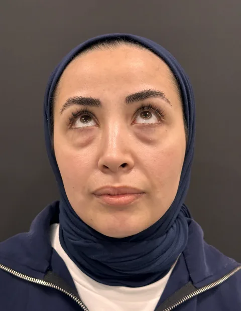 Lower blepharoplasty before and after — case 2, photo 5