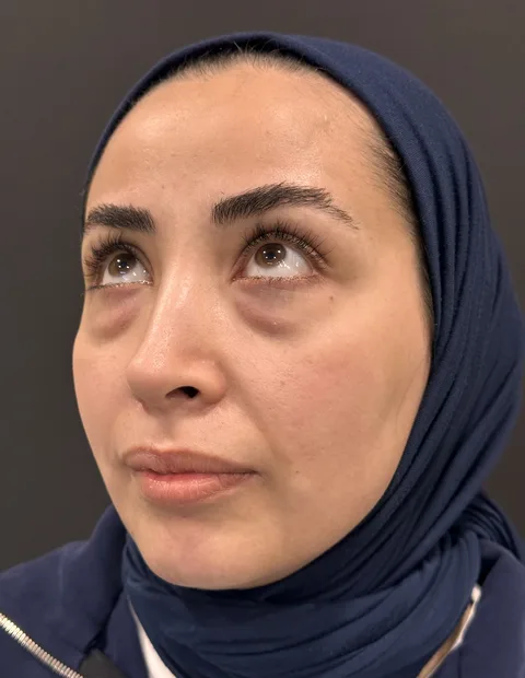 Lower blepharoplasty before and after — case 2, photo 6