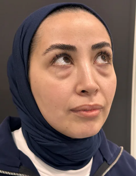 Lower blepharoplasty before and after — case 2, photo 7