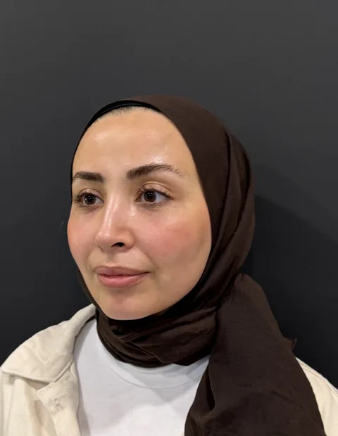 Lower blepharoplasty before and after — case 2, photo 8
