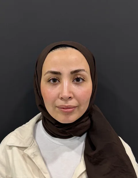 Lower blepharoplasty before and after — case 2, photo 9