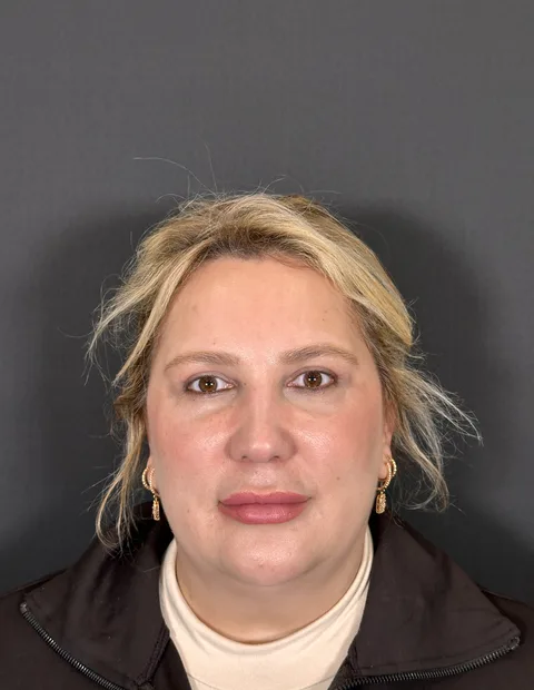 Lower blepharoplasty before and after — case 3, photo 1