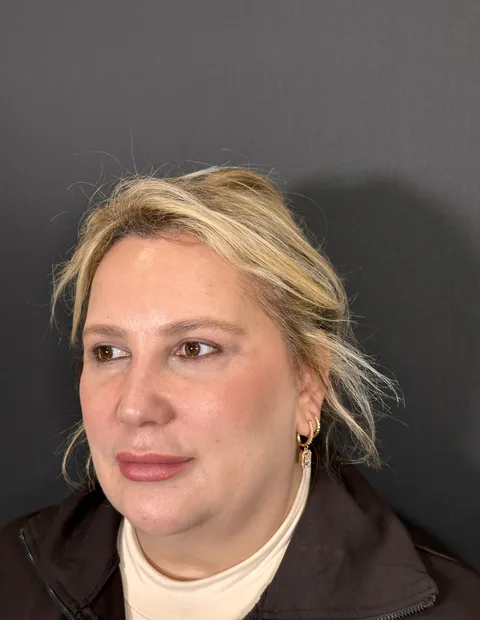 Lower blepharoplasty before and after — case 3, photo 2