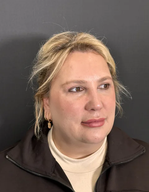 Lower blepharoplasty before and after — case 3, photo 3