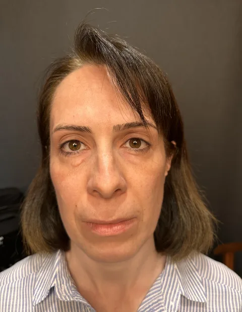 Lower blepharoplasty before and after — case 4, photo 1