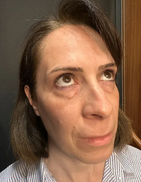 Lower blepharoplasty before and after — case 4, photo 2