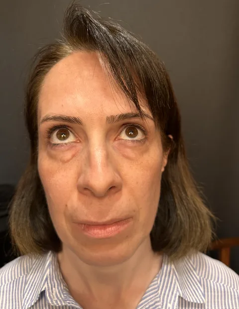 Lower blepharoplasty before and after — case 4, photo 3