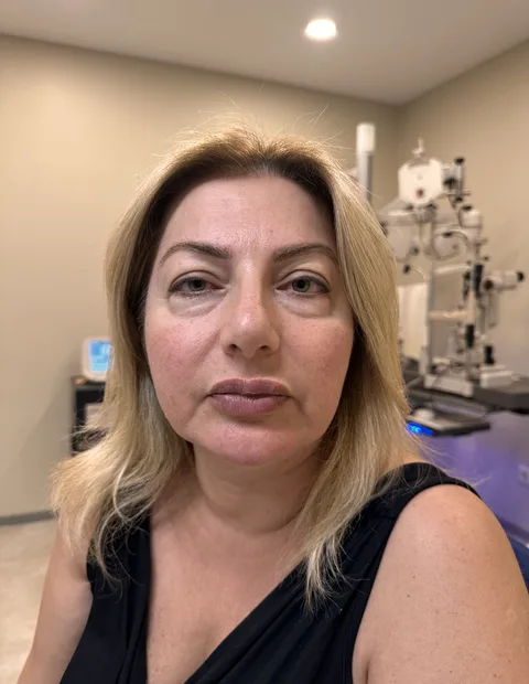 Lower blepharoplasty before and after — case 5, photo 1