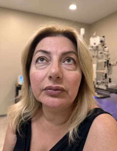 Lower blepharoplasty before and after — case 5, photo 2