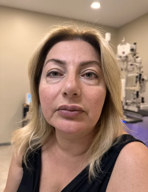 Lower blepharoplasty before and after — case 5, photo 3