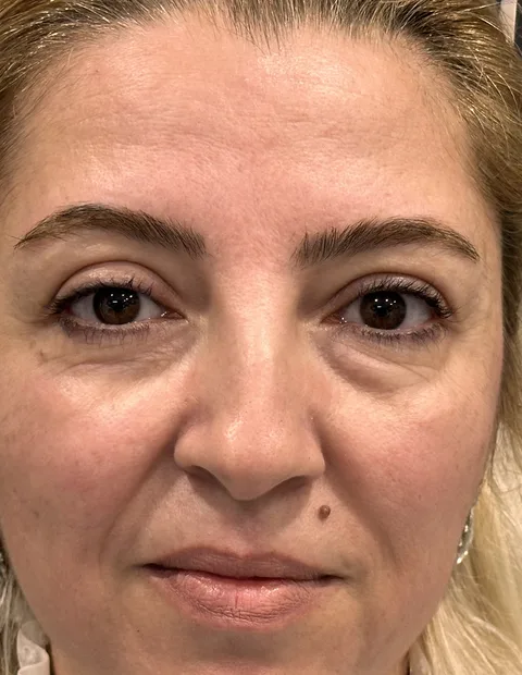 Lower blepharoplasty before and after — case 6, photo 2