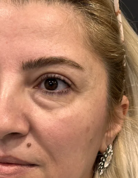Lower blepharoplasty before and after — case 6, photo 3