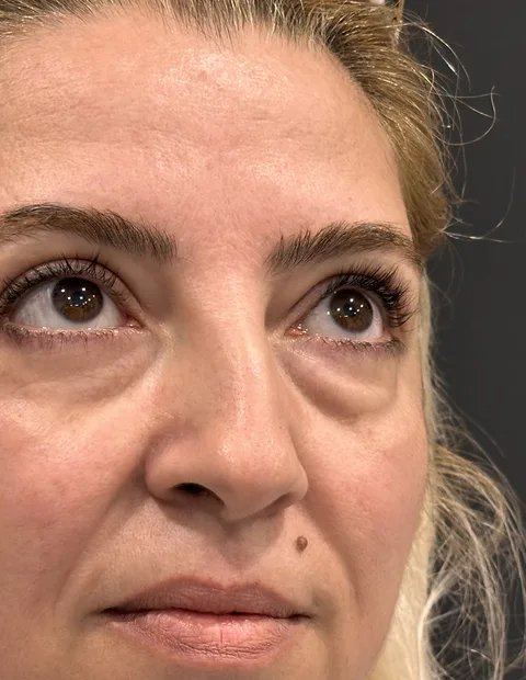 Lower blepharoplasty before and after — case 6, photo 4