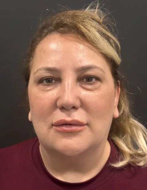 Lower blepharoplasty before and after — case 7, photo 1