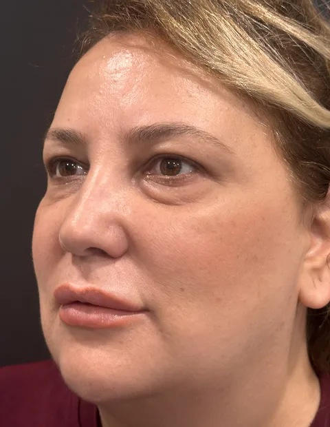 Lower blepharoplasty before and after — case 7, photo 2