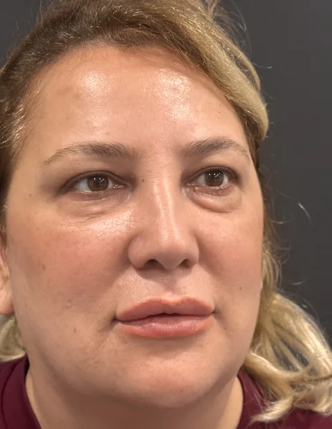 Lower blepharoplasty before and after — case 7, photo 3