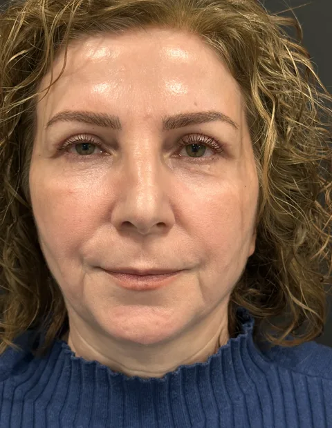 Lower blepharoplasty before and after — case 8, photo 1