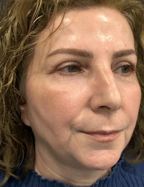 Lower blepharoplasty before and after — case 8, photo 2