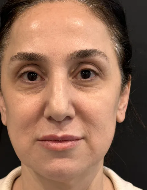 Lower blepharoplasty before and after — case 8, photo 3