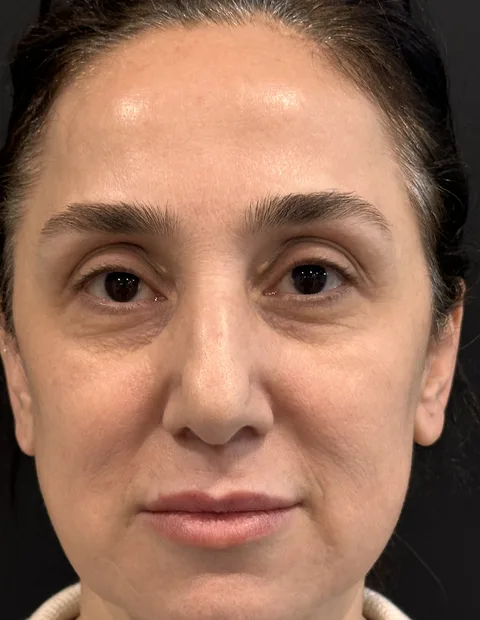 Lower blepharoplasty before and after — case 8, photo 4