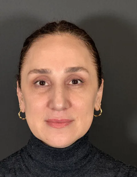 Lower blepharoplasty before and after — case 8, photo 5
