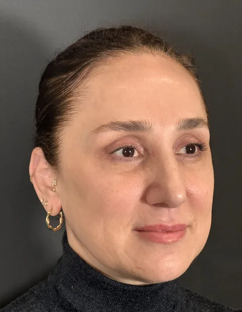 Lower blepharoplasty before and after — case 8, photo 6