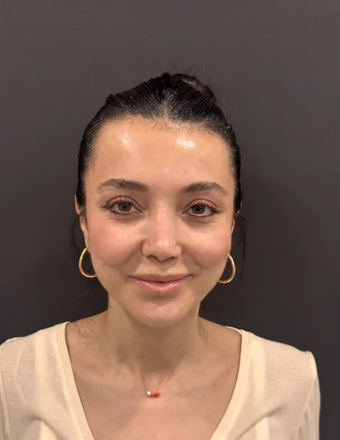Lower blepharoplasty before and after — case 9, photo 1