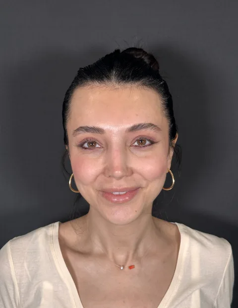 Lower blepharoplasty before and after — case 9, photo 2