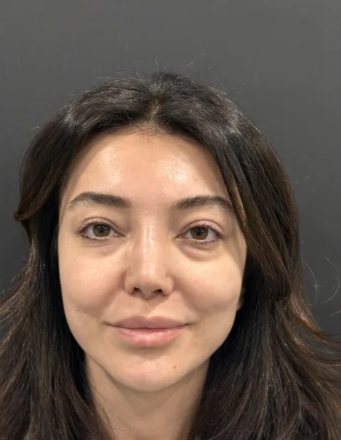 Lower blepharoplasty before and after — case 9, photo 3