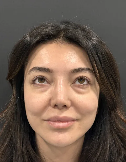 Lower blepharoplasty before and after — case 9, photo 4
