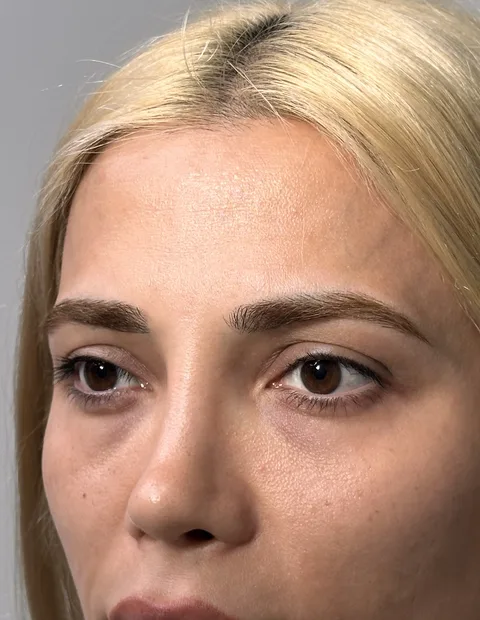 Kaş kaldırma öncesi sonrası — 1. vaka, 2. kare