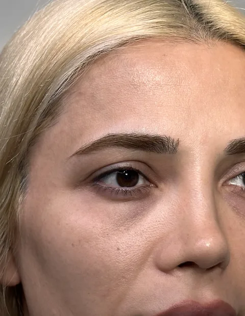 Kaş kaldırma öncesi sonrası — 1. vaka, 5. kare
