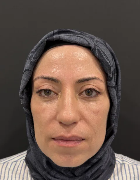 Kaş kaldırma öncesi sonrası — 2. vaka, 2. kare