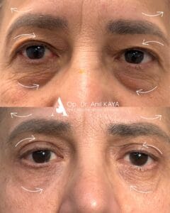 dr-anil-kaya-once-sonra-10