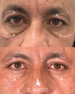 dr-anil-kaya-once-sonra-2
