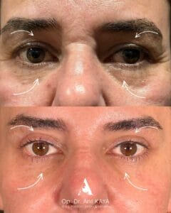 dr-anil-kaya-once-sonra-4