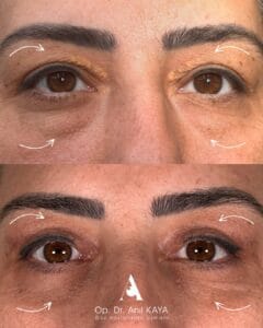 dr-anil-kaya-once-sonra-5