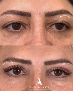 dr-anil-kaya-once-sonra-6